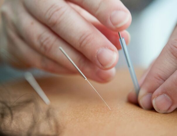 Acupuntura